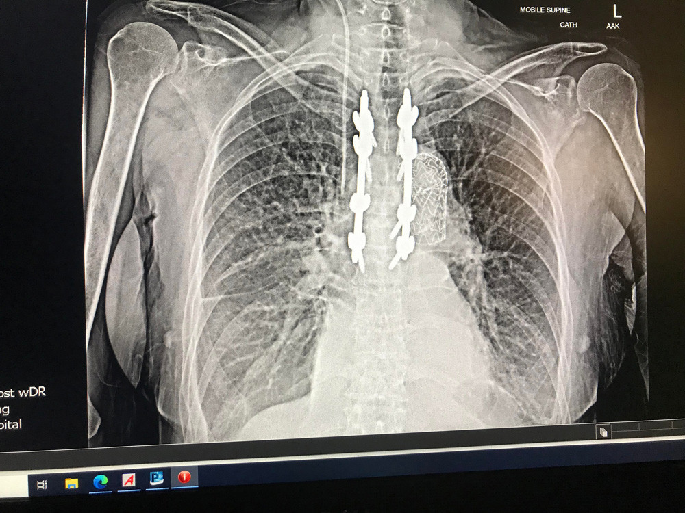 An xray of Donna’s back showing the heart stent on the right and the screws in her vertebrae.