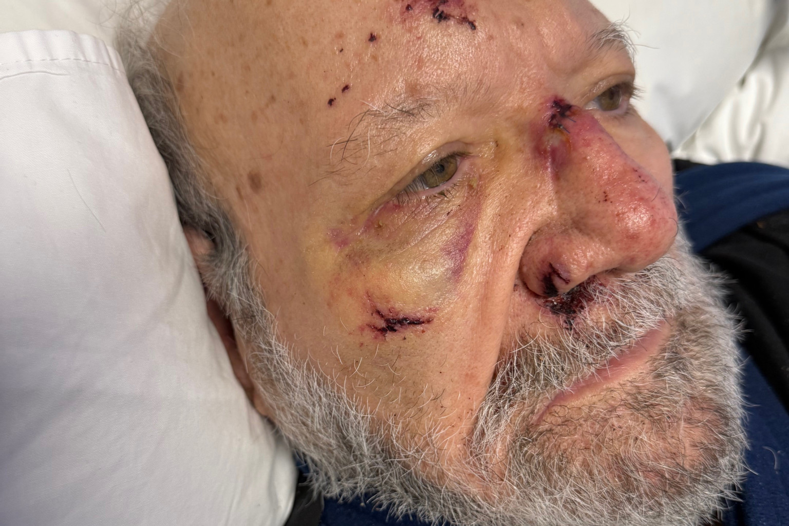 Joe Manitta is in Mareeba Hospital suffering two broken arms, a broken nose, shattered cheek bone and internal bleeding after being attacked last Thursday.