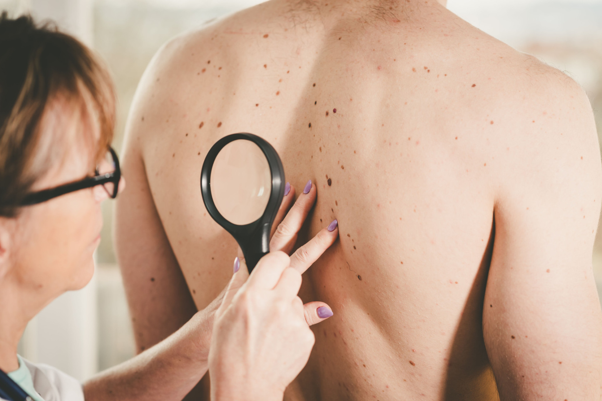 New campaign drives skin cancer message - feature photo