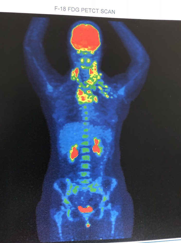 A PET Scan showing the cancer in Georgia’s body from 2018